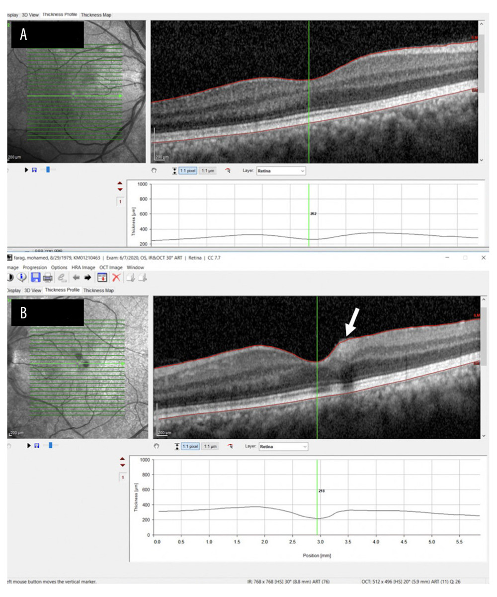 Optical coherence tomography scans. (A) In the right eye, the anatomy is normal. (B) In the left eye, a parafoveal intraretinal hemorrhage is visible but there is no clinically significant macular edema.