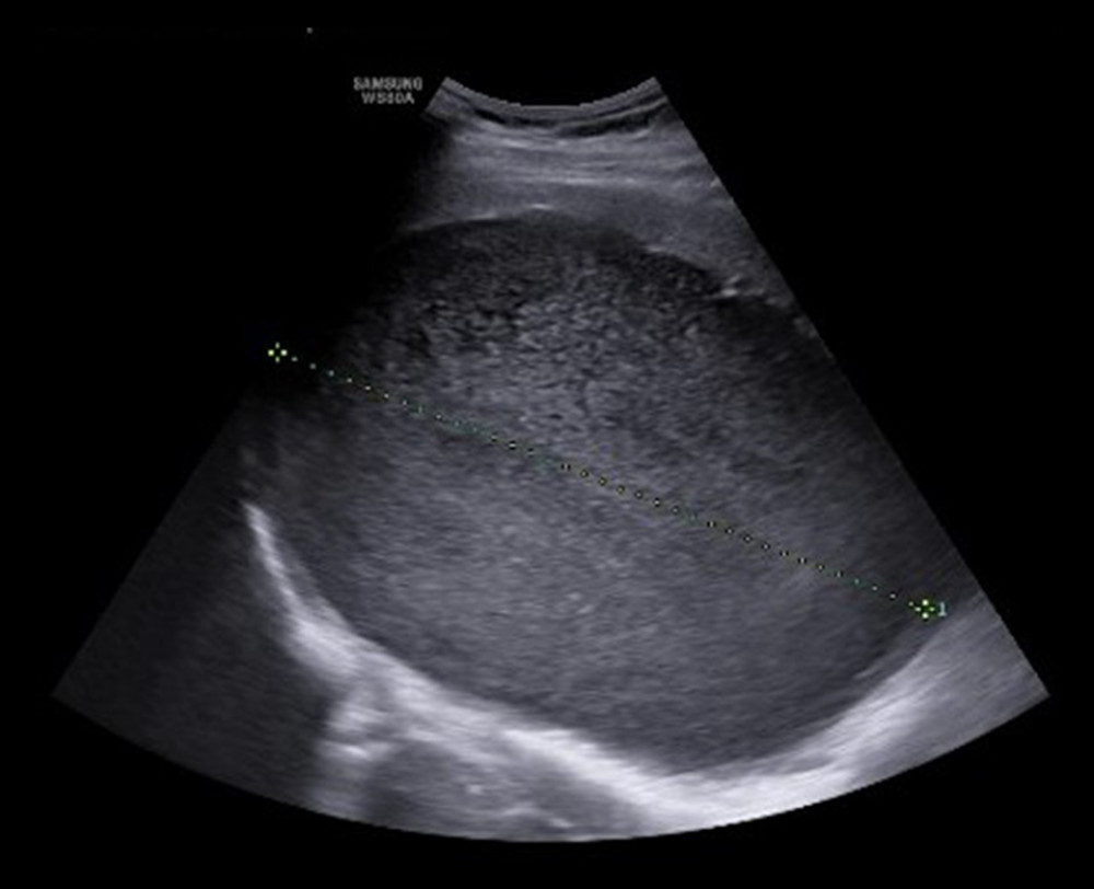 Ultrasound image showing a large hypoechoic fluid-filled lesion with a thin wall and no solid component.