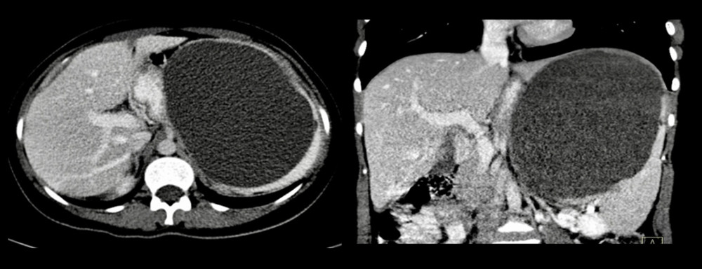 Contrast-enhanced computed tomography scan demonstrating a large homogenous hypodense cystic lesion within the spleen. There is no discernable enhancing wall and the lack of a solid component and septations are noted. These radiologic features are consistent with a simple splenic cyst.