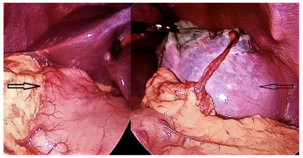 Laparoscopic exploration demonstrating a giant splenic cyst (arrow) arising within the upper pole of the spleen and occupying almost its entire surface. The stomach is seen displaced to the right lobe of the liver (arrow).