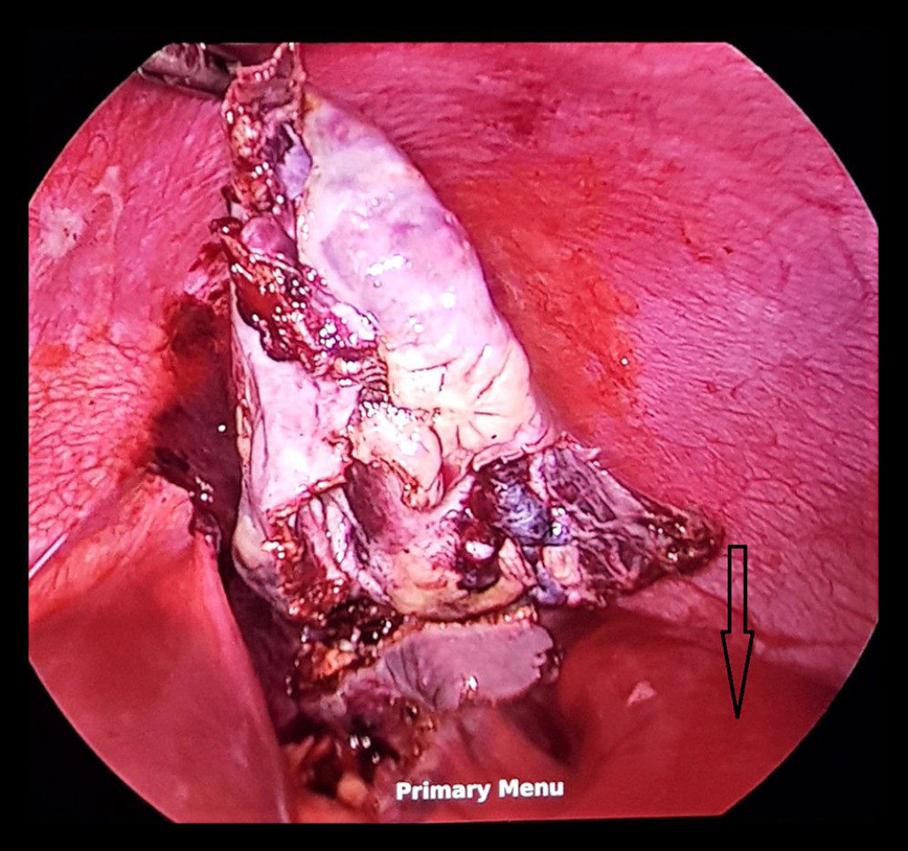 Laparoscopic decapsulation of splenic cyst with splenic preservation (arrow on spleen).