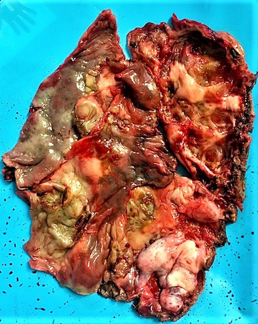 Gross aspect of the cyst showing a glistering inner surface with heavily trabeculated appearance (resembling endocardium).