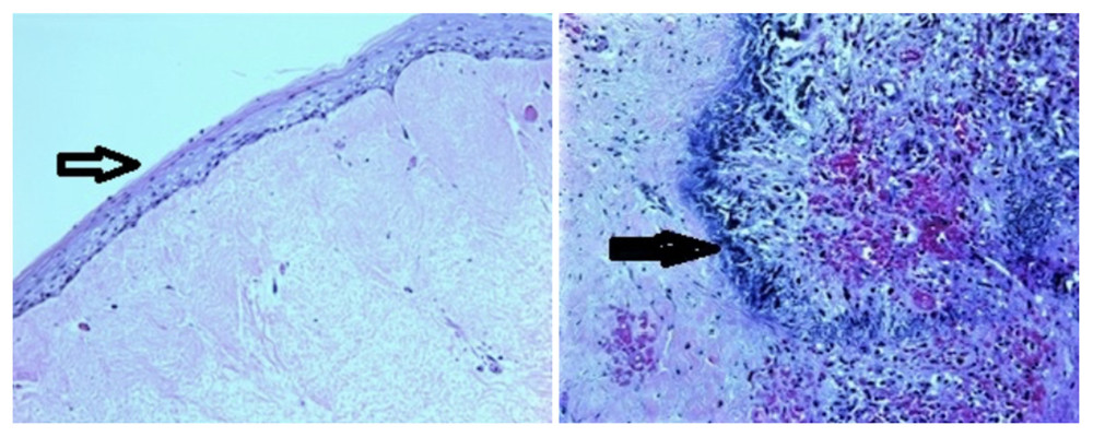 Histopathologic examination revealing nonkeratinized squamous epithelial lining (thin arrow) and Gamna-Gandy body seen in the cyst (thick arrow), both stained with hematoxylin and eosin. Features are consistent with a primary splenic cyst.