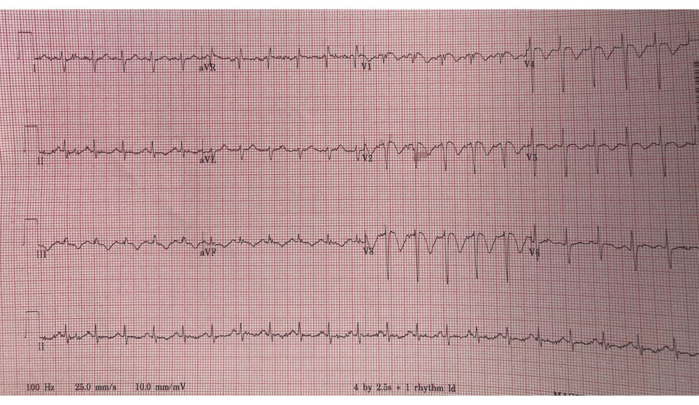 EKG showing sinus tachycardia with ST-elevation from V1 to V3 with deep T-wave inversions in the precordial leads.