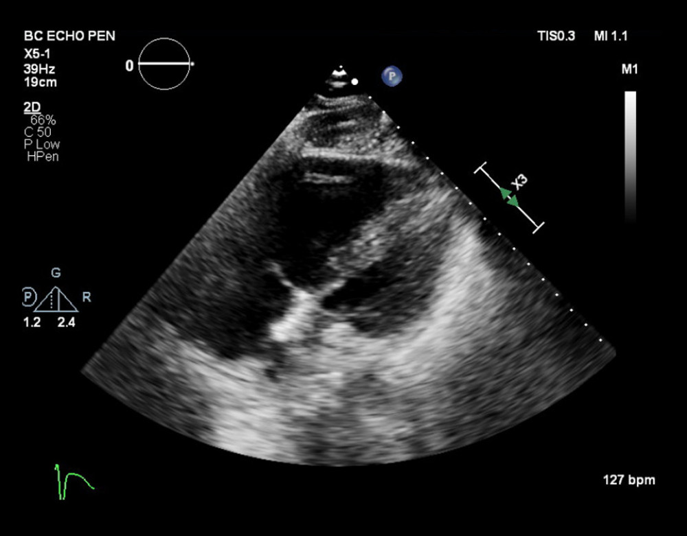 Modified apical right ventricular focused view of echocardiogram showing right ventricular strain.