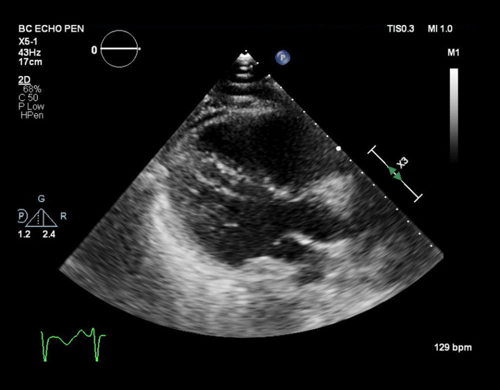 Parasternal long axis view of echocardiogram showing septal deviation due to pressure overload in right ventricle.