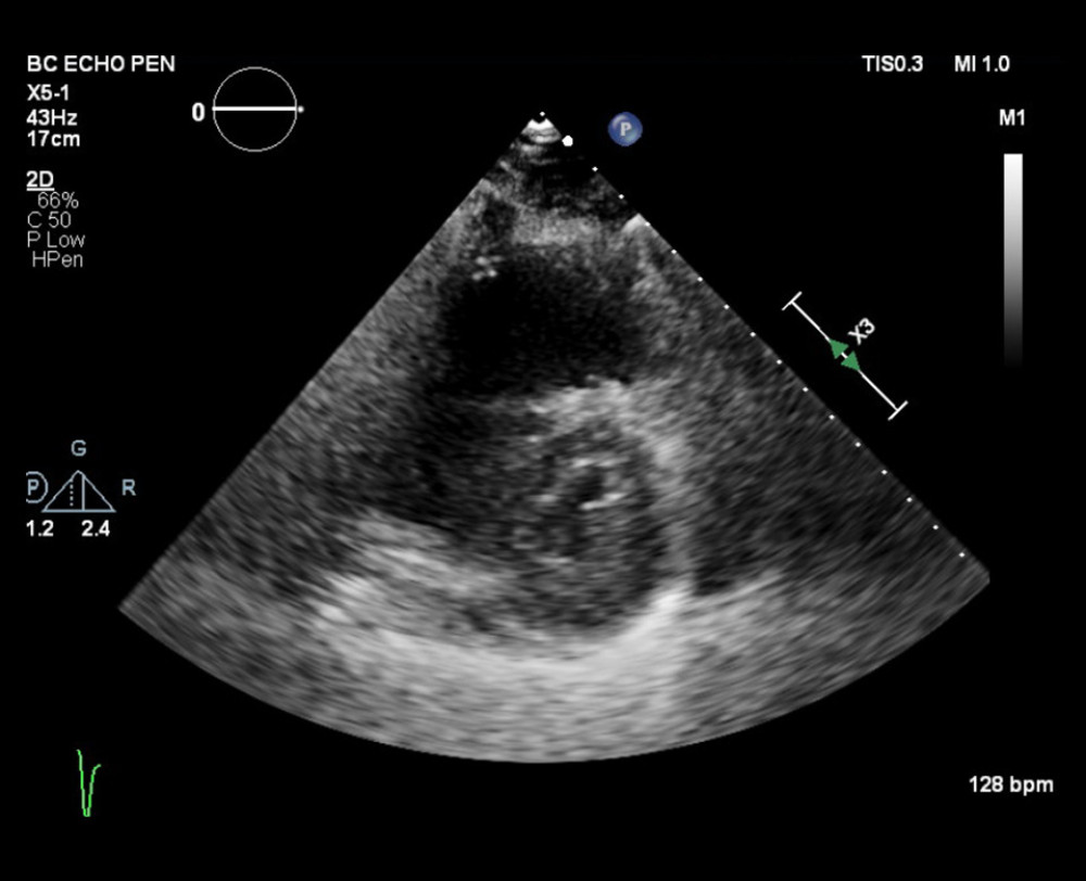 Parasternal short axis view at papillary muscle level showing right ventricular pressure overload and D-shaped septum.