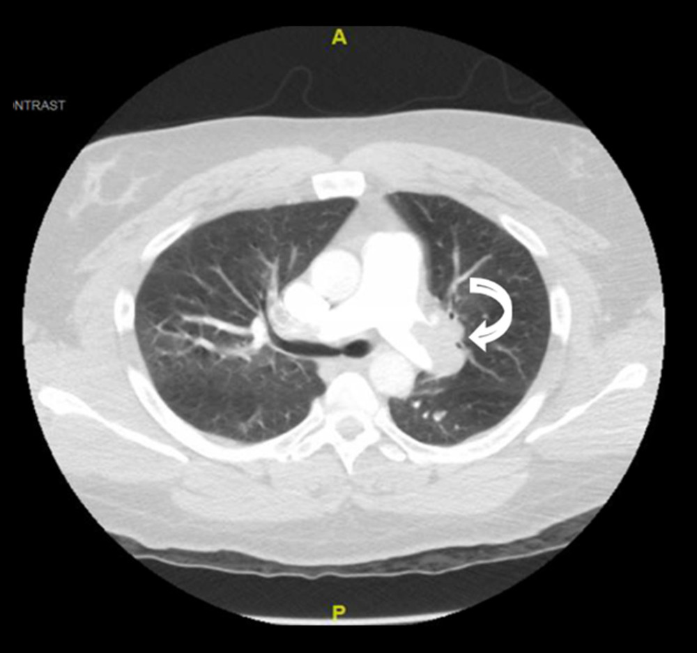 Computed tomography angiogram of the chest showing large filling defects within the main pulmonary arteries, suggestive of acute pulmonary embolism.