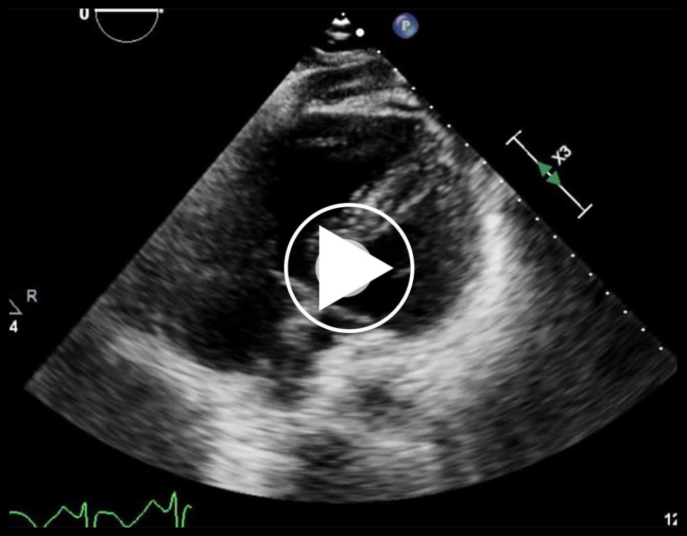 Echocardiogram showing McConnell’s sig: right ventricular free-wall akinesis with sparing of the apex.