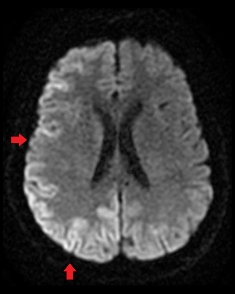 Magnetic resonance imaging of the head showing cortical ribboning and subtle diffusion-weighted imaging abnormality of gray-matter structures at the bilateral occipital, parietal, and right frontal lobe, with fluid-attenuated inversion recovery (FLAIR) hyperintensity in the right frontal cortex (arrows).