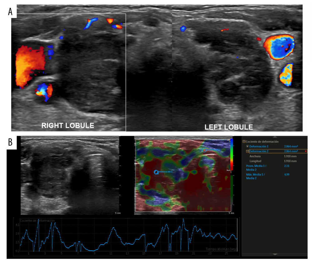 Doppler ultrasound of the thyroid gland. (A) Diffuse, nonvascular enlargement of both thyroid lobules can be seen with discrete pseudonodule structures. (B) Strain elastography demonstrates a severe diffuse increase in thyroid tissue rigidity (mean 4.99, reference value 1).