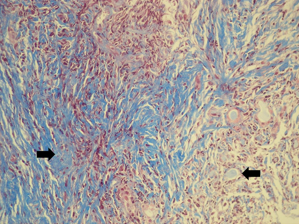 20× Masson’s Trichrome. The thyroid parenchyma is almost completely replaced by blue collagen fibers in keloid-like bands (left arrow). Residual colloid follicles are present (right arrow).
