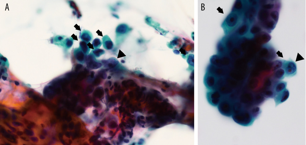 Pathological examination with trans-bronchial lung biopsy. (A, B) Atypical cells with enlarged and irregular nucleus (arrows) and clear nucleolus (arrow heads) are shown.