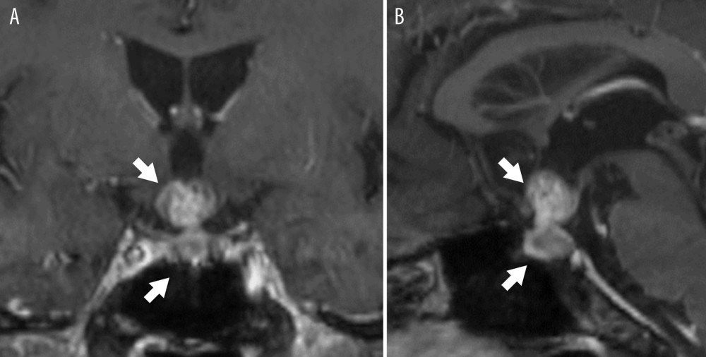 Head magnetic resonance imaging. Enhanced dumbbell-type pituitary tumor with suprasellar extension (arrows). (A) Frontal section and (B) sagittal section are shown.
