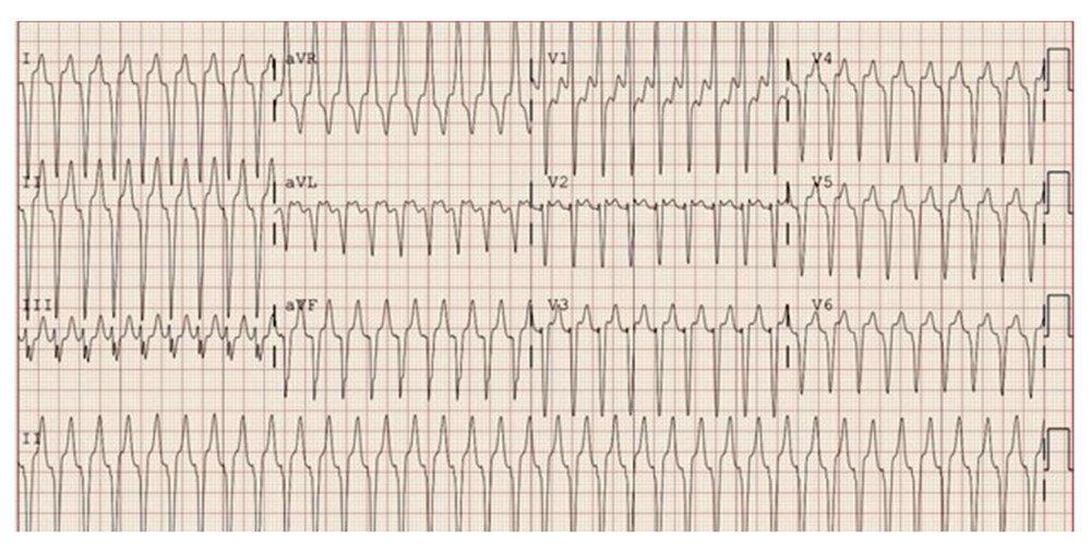Twelve-lead electrocardiogram showing a regular, wide QRS tachycardia at a rate of 188 beats per minute in a patient with dextrocardia.