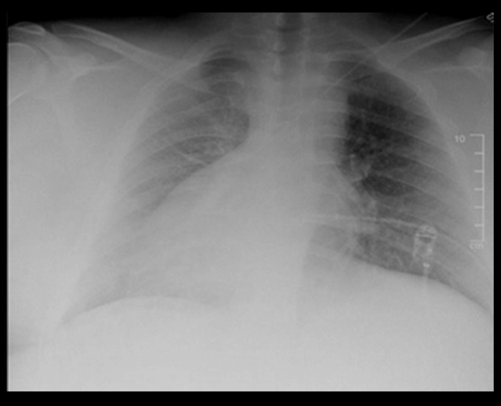 Chest X-ray showing dextrocardia and deformity of the right fourth rib.