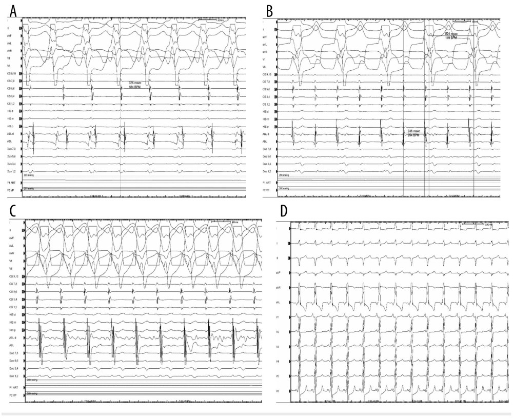 Intracardiac electrocardiography with precordial leads and lead 1 reversal showing (A) wide complex tachycardia; (B) 2: 1 atrial flutter; (C) atrial tachycardia with 1: 1 conduction, and (D) normal sinus rhythm.