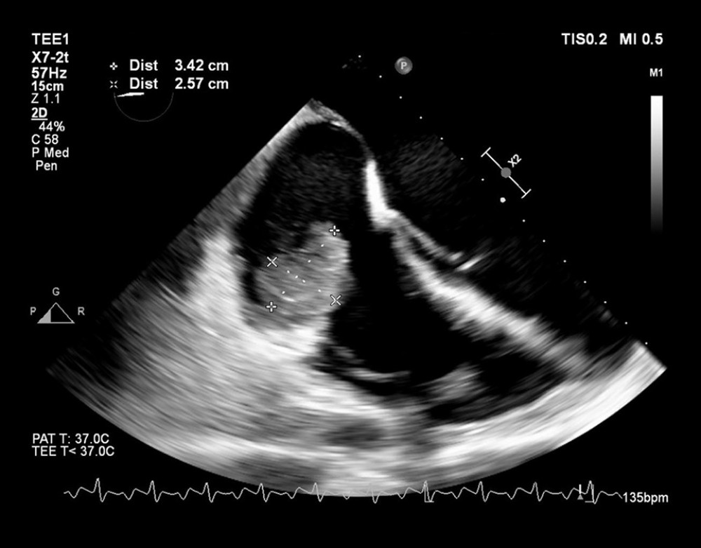 Section from the transesophageal echocardiogram showing a large mass on the annulus of the tricuspid valve. Maximum dimensions were 4.5×3.5 cm; the view from this section shows dimensions at 3.4×2.6 cm.
