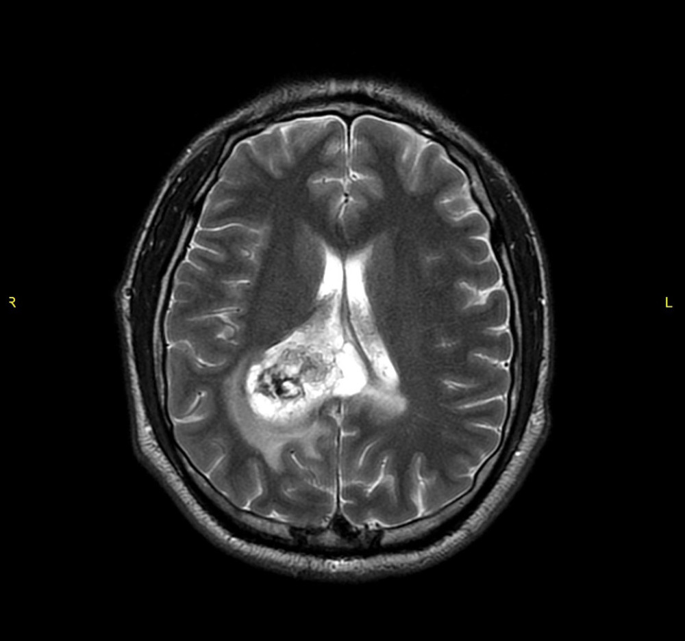 MRI brain T2-weighted axial image demonstrates an ill-defined lobulated heterogeneous large mass within the posterior horn of the right lateral ventricle.