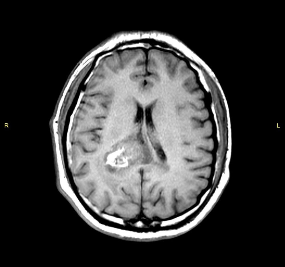 MRI brain T1-weighted axial pre-contrast image demonstrates heterogeneous signal with areas of hyperintensity.