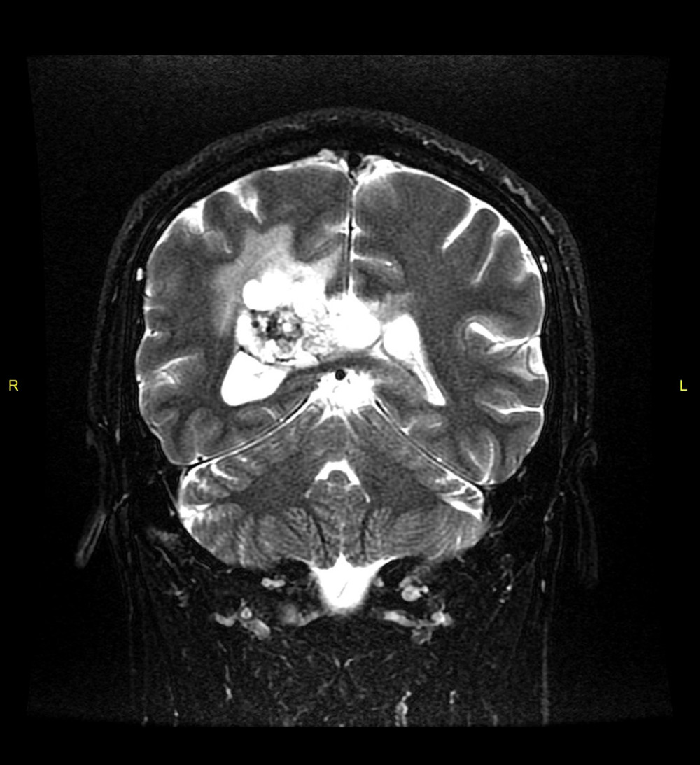 MRI brain T2-weighted coronal fat-suppression image demonstrates isolated dilatation of the posterior horn of the right lateral ventricle with extension to the right parietal lobe.