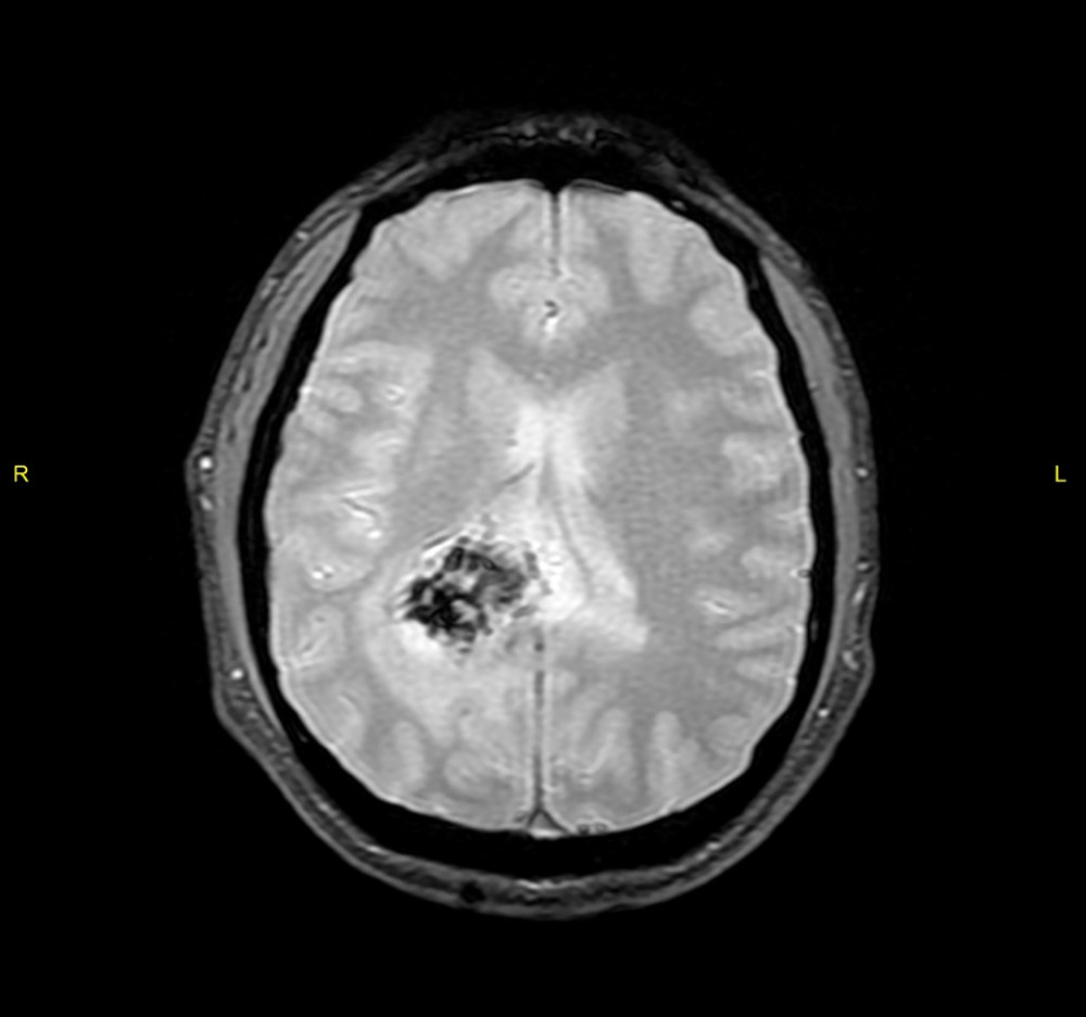 MRI brain T2-weighted axial gradient echo sequences (GRE) image demonstrates evidence of blooming.