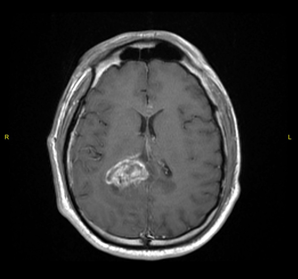 MRI brain T1-weighted axial post-contrast image demonstrates evidence of heterogenous pathological enhancement and confirm focal presence of extension to right partial lobe.