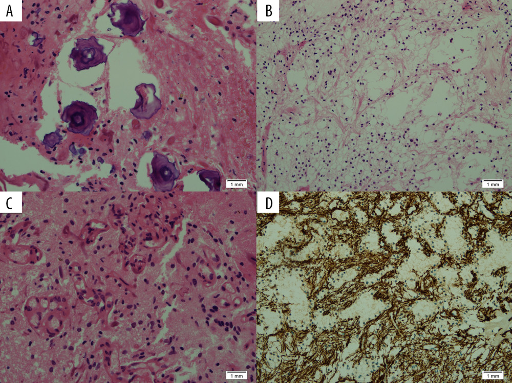 Psammoma bodies with background of degenerative atypia. H&E section, 40× (A); Microcysts formation. H&E section, 20× (B); Vascular proliferation. H&E section, 40× (C); Diffuse cytoplasmic positivity for glial fibrillary acidic protein (GFAP) immunostain, 20× (D).