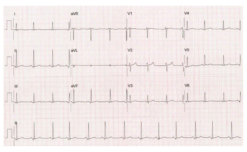 Baseline EKG.