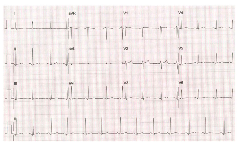 Baseline EKG.