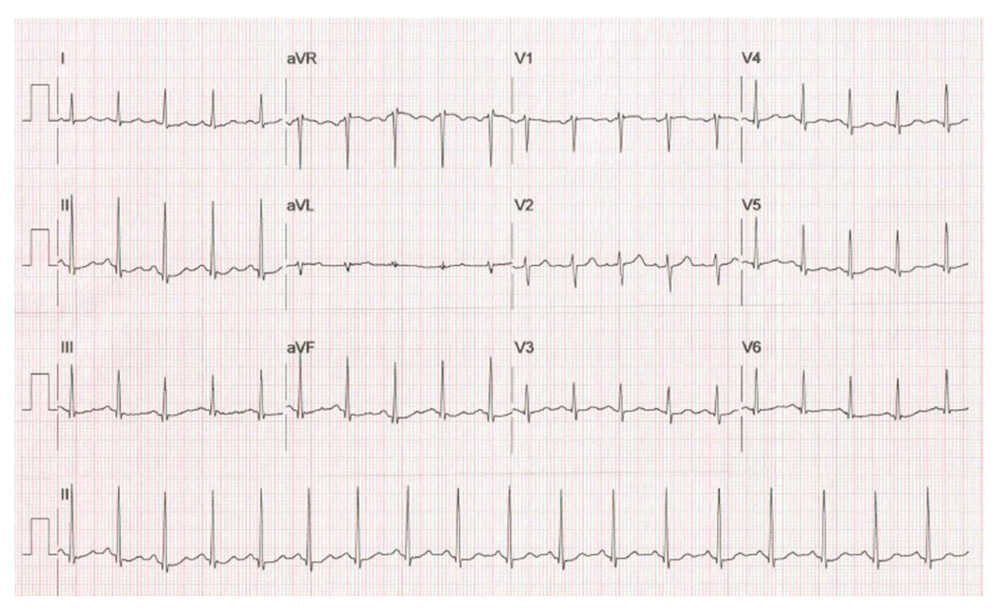 Recovery EKG.