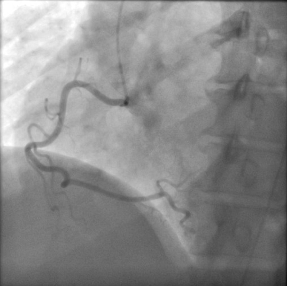 Coronary angiography of the right coronary artery (RCA) showing patent artery with no significant obstruction.