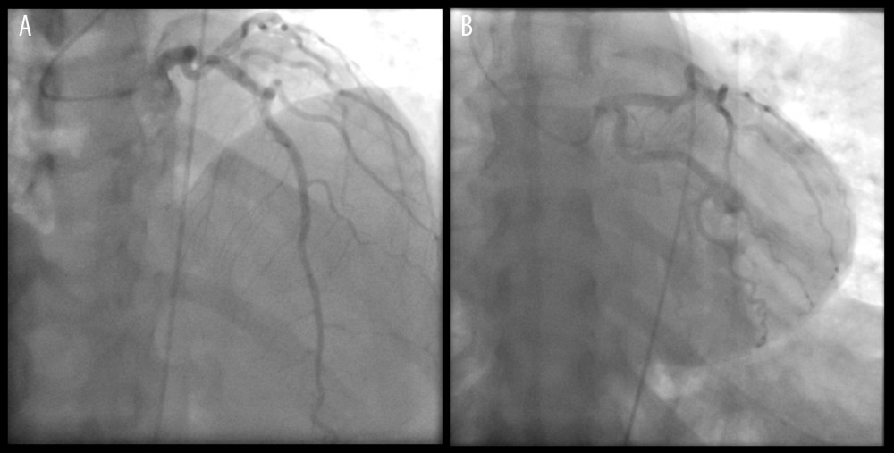 (A, B) Coronary angiography of the left coronary circulation showing no significant obstruction on the left coronary artery (LCA), left circumflex artery (LCx) and left anterior descending artery (LAD).