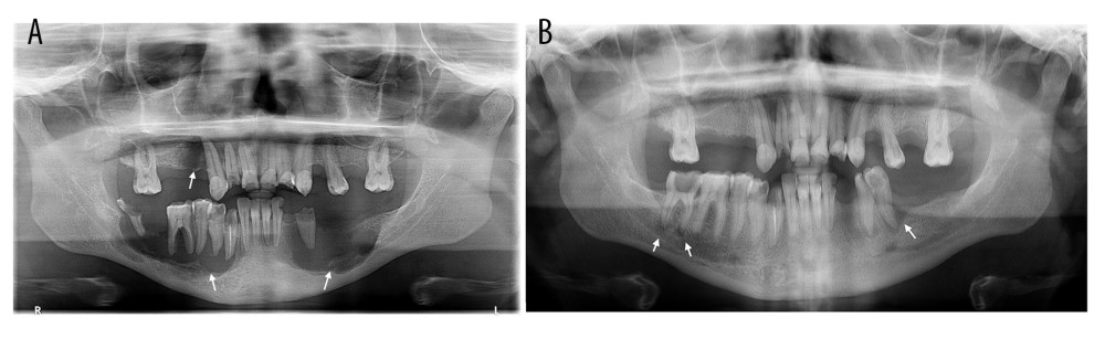 (A) An orthopantomogram (OPG) showing destructive radiolucent lesions on the mandible bilaterally and a third lesion distal to the right maxillary canine region. (B) An OPG taken 2 years earlier shows multiple small, periapical odontogenic lesions in the mandibular left premolars and the right molar.
