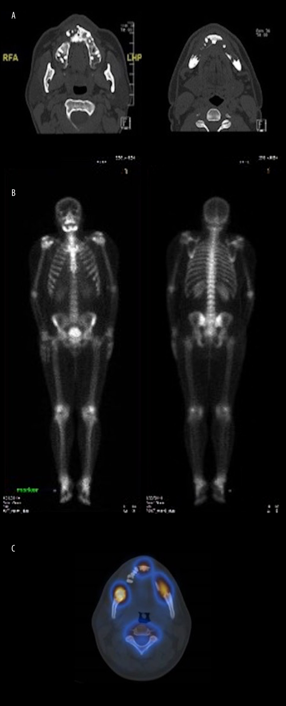 (A) Multi-detector computed tomography (CT) scans performed with bone window settings. The different axial-view slices of the maxilla and mandible show non-expansible osteolytic lesions in both the upper and lower jaws. (B) A whole-body bone CT scan showing increased uptake in the mandible. (C) A single-photon emission CT scan showing a high rate of metabolic activity in the same regions.