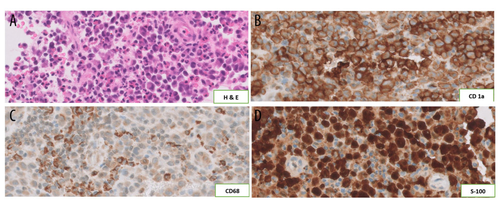 (A) A photomicrograph of a hematoxylin and eosin-stained section shows sheets of an infiltrate composed of large cells with abundant eosinophilic cytoplasm. In the background, variable numbers of inflammatory cells are present, primarily eosinophils (40×). Photomicrographs of sheets of large cells with immunohistochemical staining. (B) Immunoreactivity to CD1a antibody. (C) Immunoreactivity to CD68 antibody. (D) Immunoreactivity to S-100 antibody.
