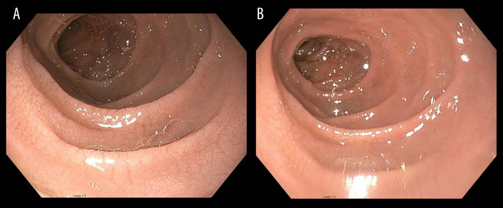 (A, B) Esophagogastroduodenoscopy (EGD) showing villous blunting of the duodenum.