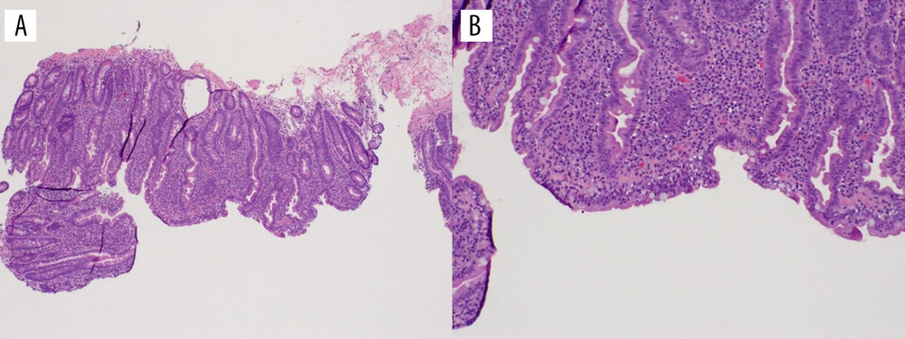 Duodenum, biopsy. Duodenal intraepithelial lymphocytosis and moderate villous blunting. (A) Hematoxylin and eosin, 40×. (B) Hematoxylin and eosin, 100×.