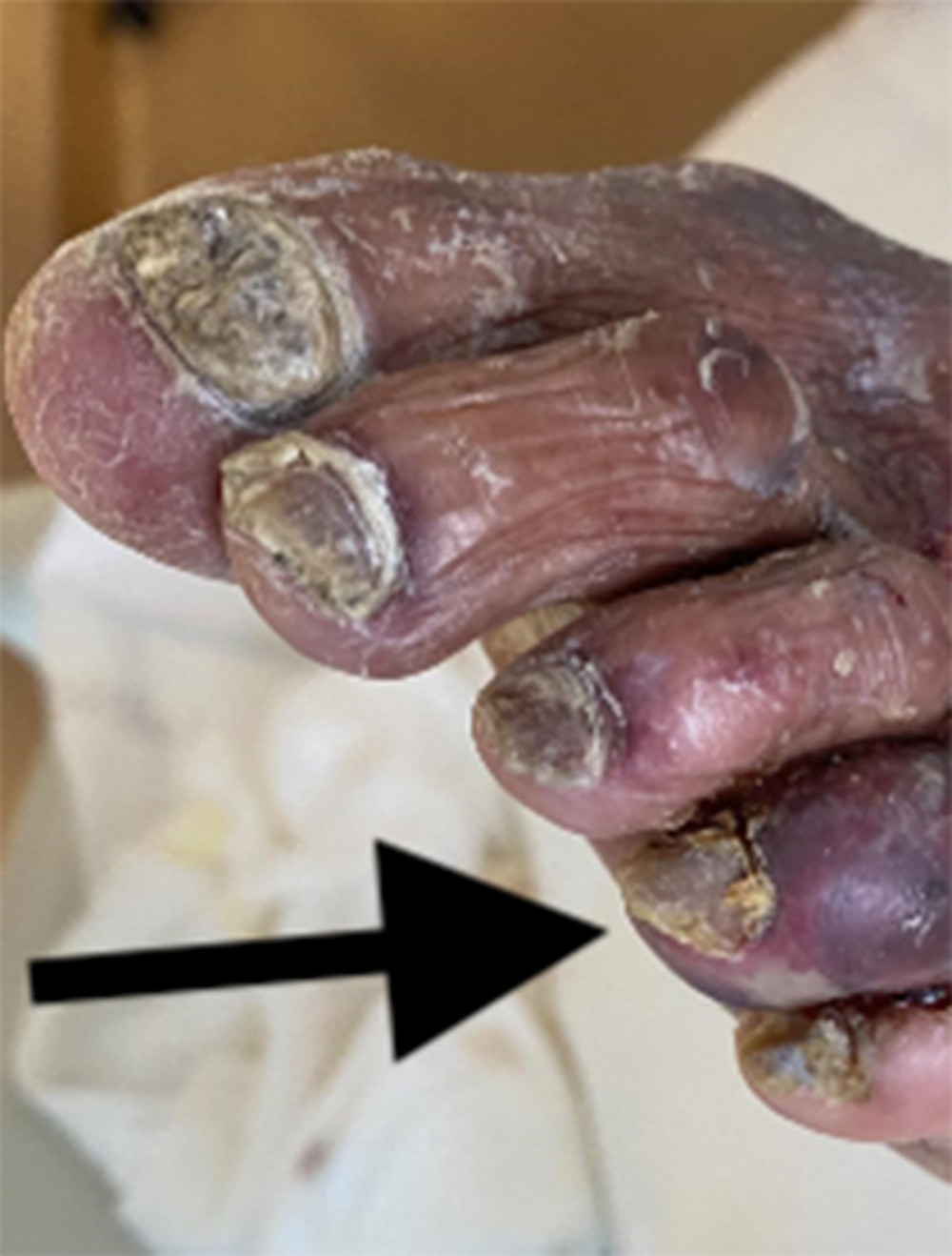 Dark arrow pointing at the gangrenous left fourth toe of the index case before commencing heparin.