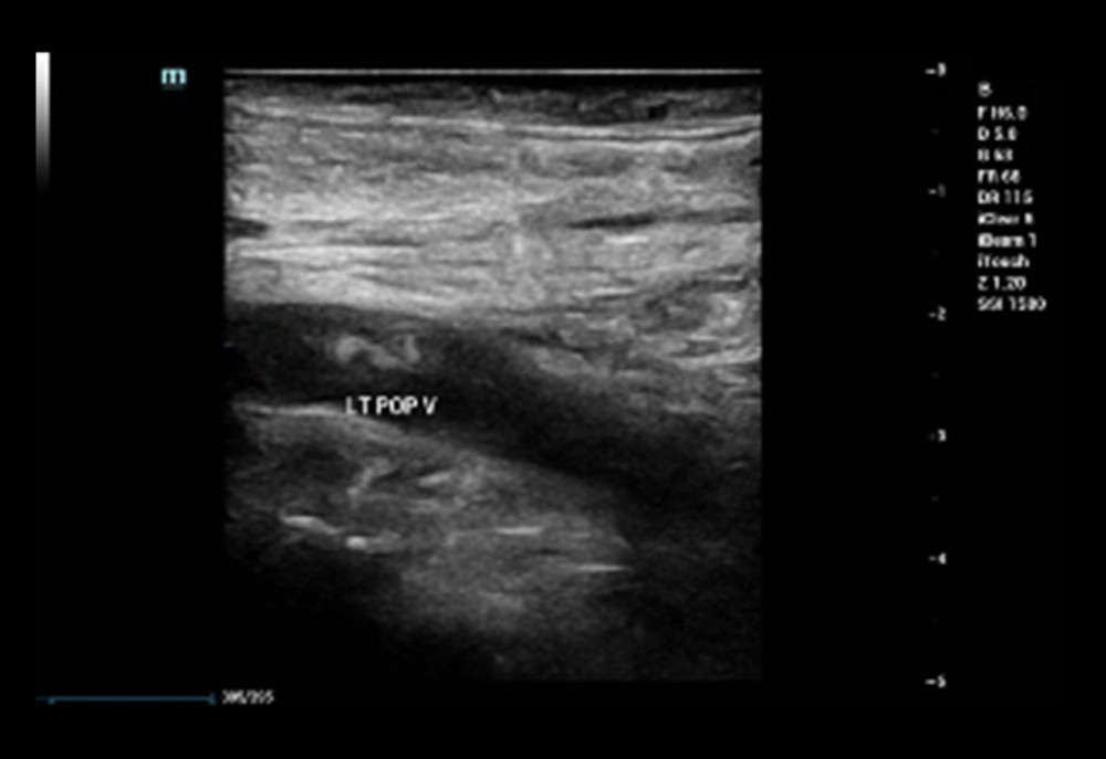 Longitudinal venous duplex during acute phase showing thrombus in the left popliteal vein.