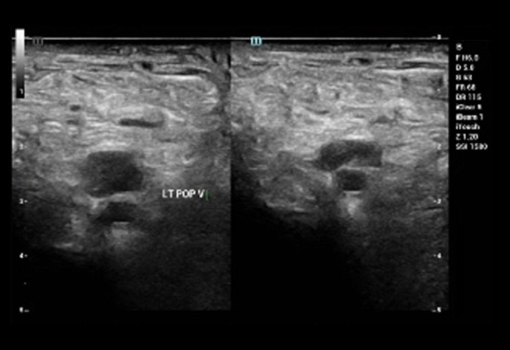 Sagittal venous duplex during acute phase showing thrombus in the left popliteal vein.