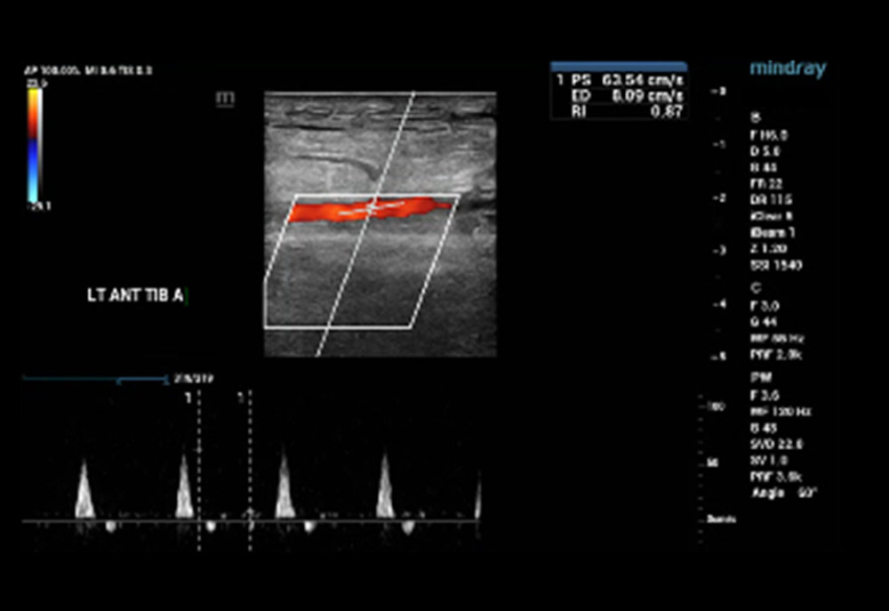 Arterial Doppler ultrasound and spectral finding of the left posterior tibial artery was normal.