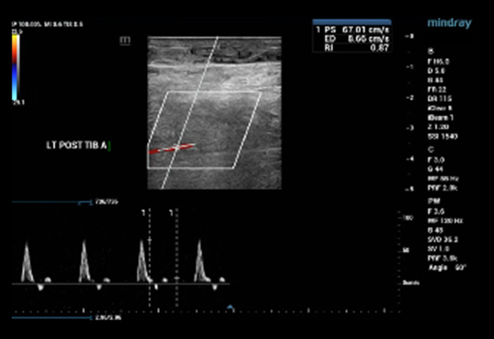 Arterial Doppler ultrasound with the color flow of the left anterior tibial artery was normal.