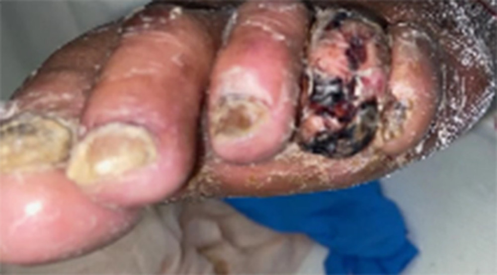 Improved vitalization of the left fourth toe of the index case after commencing heparin.