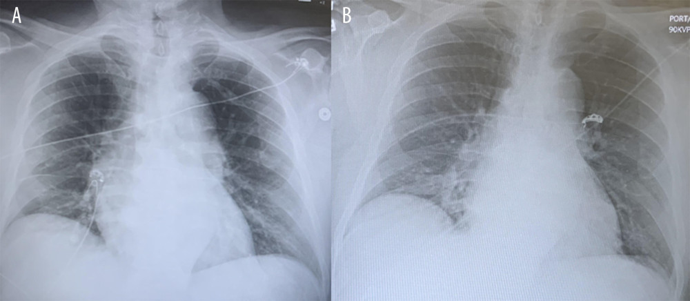 Chest X-ray findings upon admission (A) and upon leaving the intensive care unit (B) for patient in case 1.