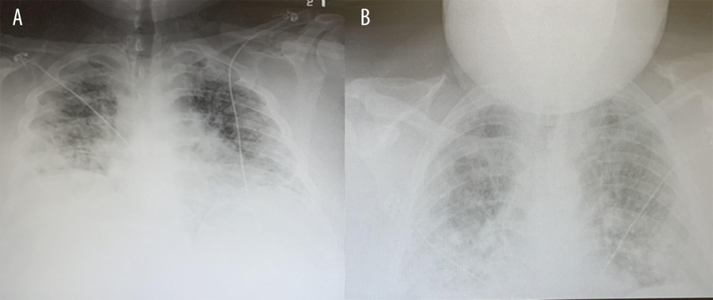 Chest X-ray findings upon admission (A) and upon leaving the intensive care unit (B) for patient in case 2.