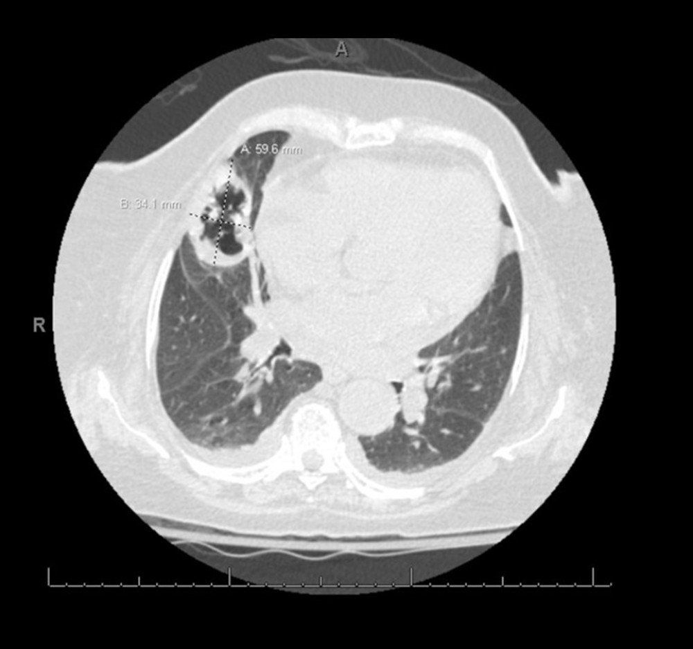 High-resolution computed tomography scan of a new cavitary mass in the right middle lobe measuring 6×3.5 cm, indicating formation of invasive pulmonary aspergillosis.