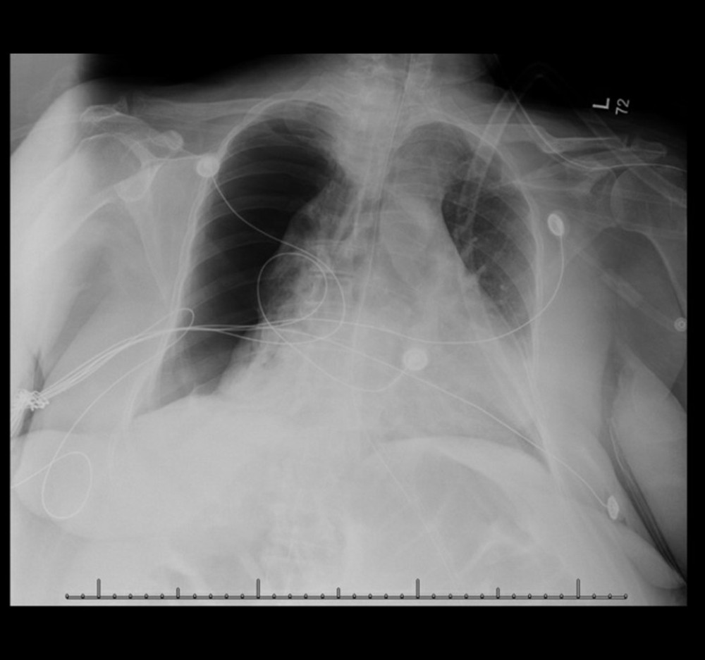 Chest X-ray with large right-sided pneumothorax with a minimal right to left mediastinal shift that initially resolved with a chest tube but then reformed.