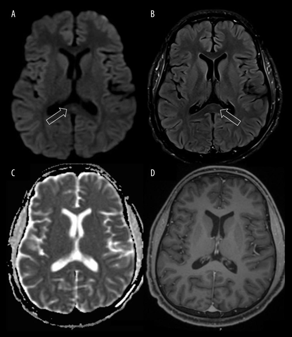 Brain Magnetic resonance imaging (MRI) on admission. Diffusion-weighted (A) and fluid-attenuated inversion recovery (B) imaging demonstrates a hyperintense signal in the splenium of corpus callosum, with associated loss of signal on apparent diffusion coefficient maps (C) corresponding to restricted diffusion. T1-weighted images with contrast (D) showed an isointense signal without contrast enhancement. These findings were suggestive of cytotoxic lesion of corpus callosum. Arrows indicate the splenium of the corpus callosum.