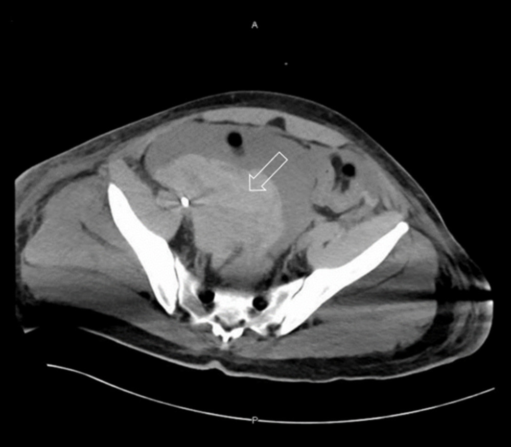 Abdominal Computed tomography (CT) scan on hospital day 9. Hypodense elements suggestive of intraperitoneal hemorrhage (seen in non-contrast). Main bulk of the hemorrhage is seen in the right side of the pelvis (arrow). Source of active bleeding cannot be determined.